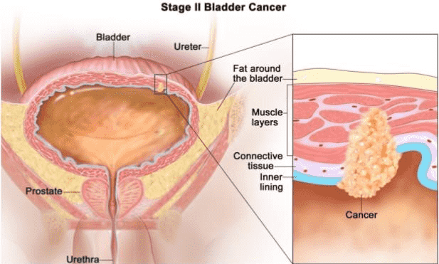 уретроцистоскопия с биопсией рака мочевого пузыря информация фото