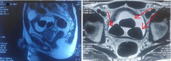Магнитно-резонансная томография предстательной железы с контрастированием