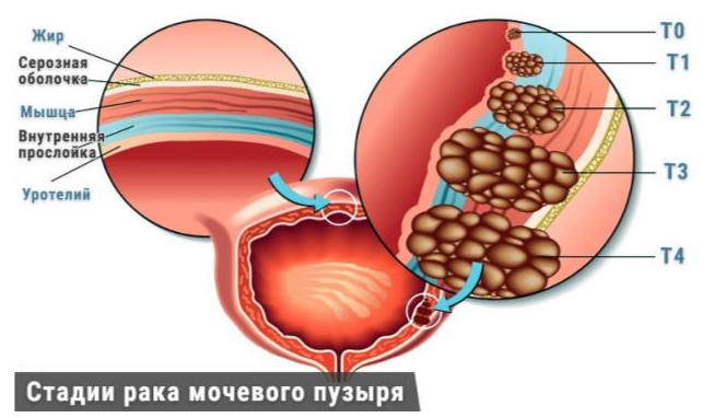 Рак мочевого пузыря (стенки) №30 - Услуги уролога в Москве | Мамедкасимов Нариман Акитович