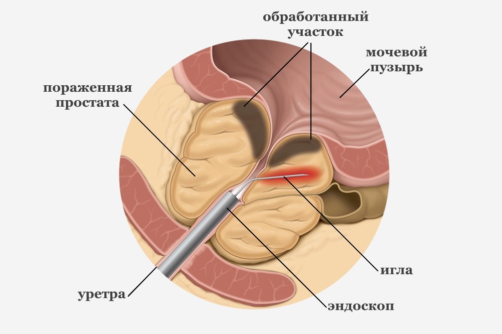 Обзор метода лечения простатита по Неумывакину (с видео)