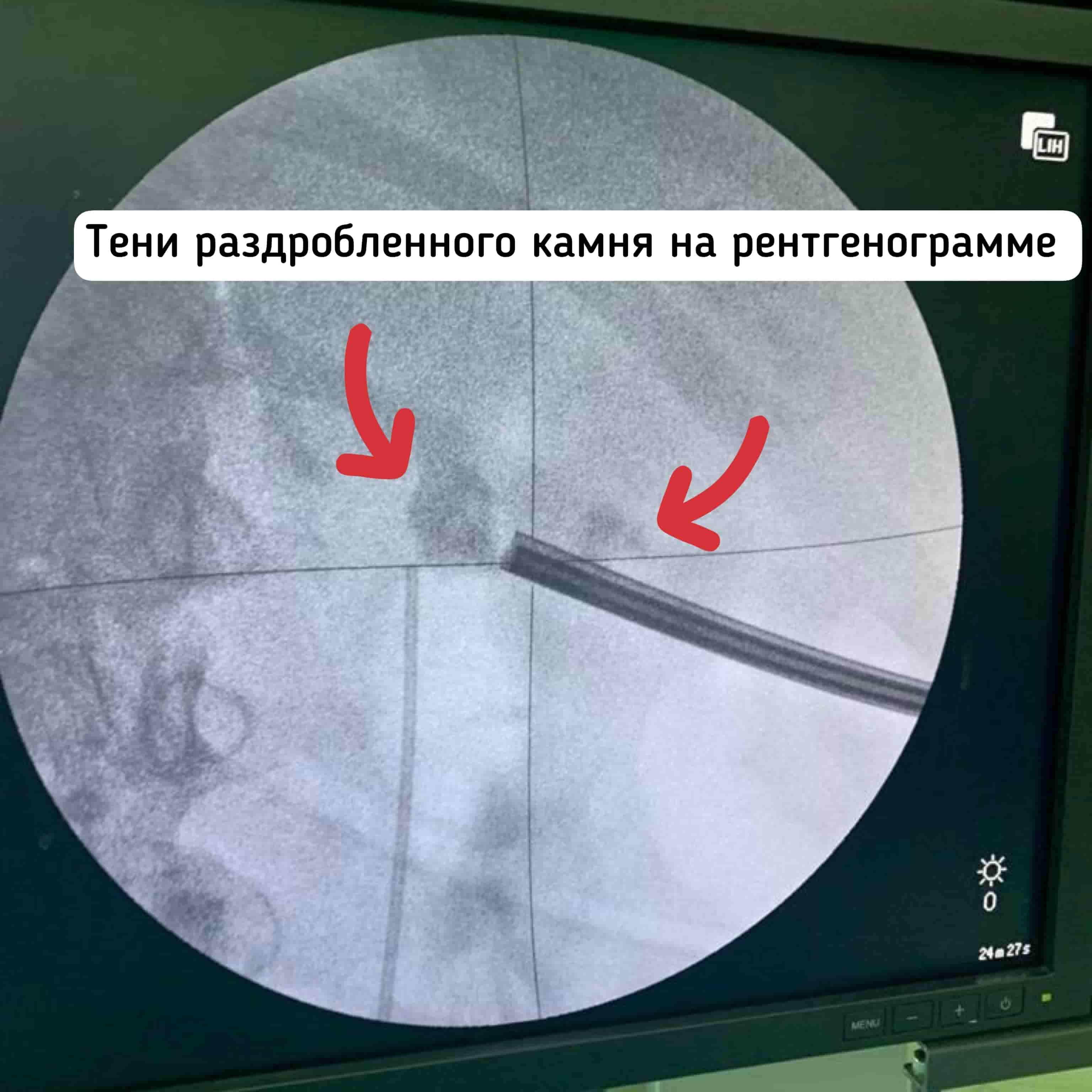 Удаление камня 4 см из почки в Москве, операция лазерное волокно, ультразвук
