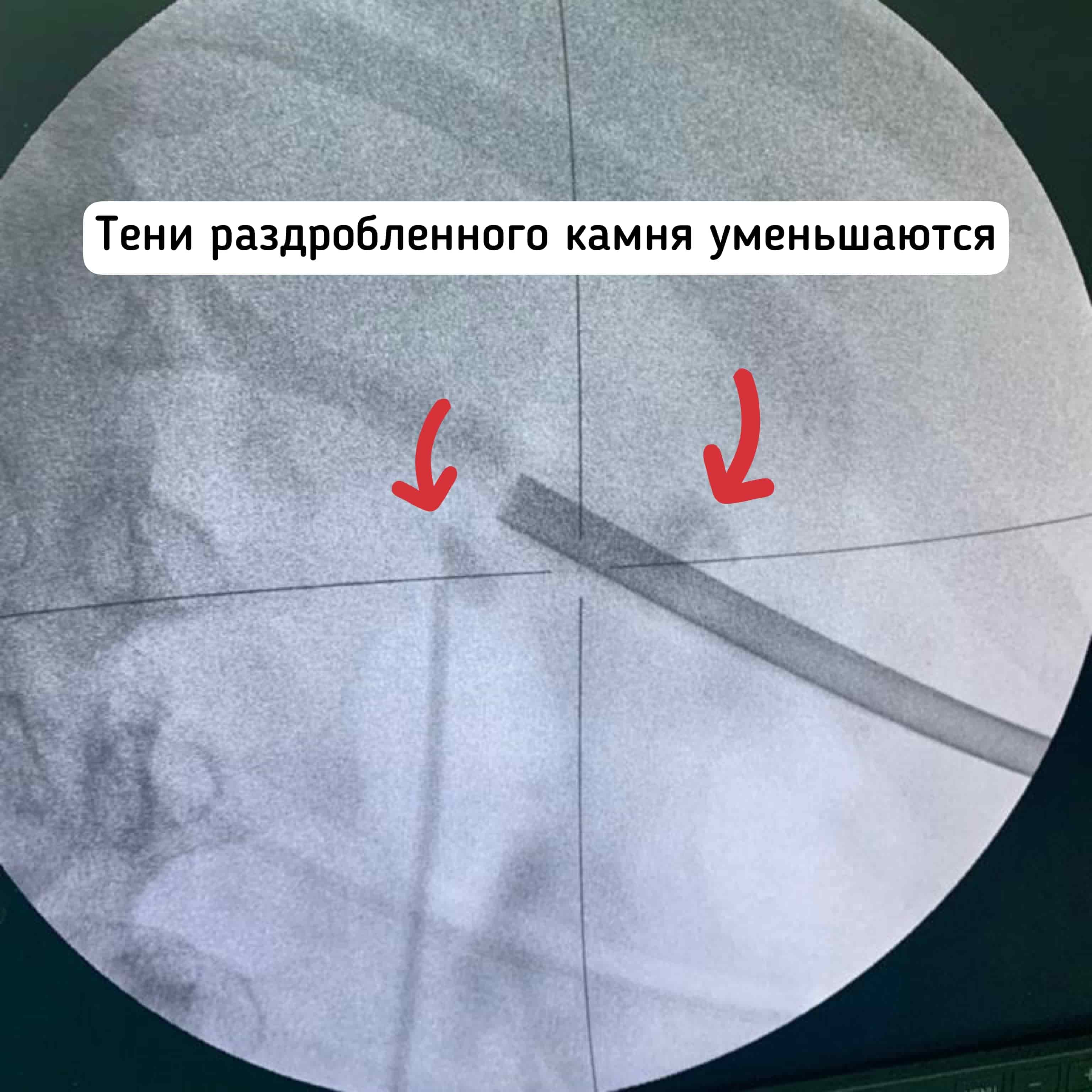 Удаление камня 4 см из почки в Москве, операция лазерное волокно, ультразвук